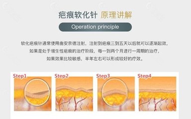 疤痕软化针的价格