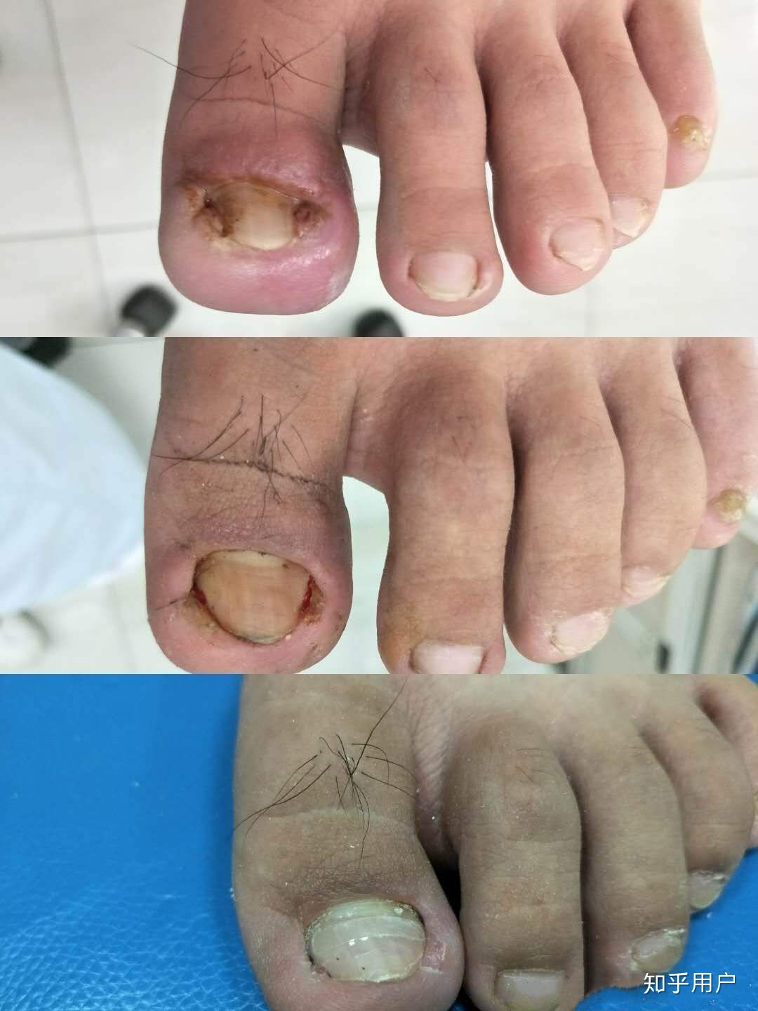 脚趾甲增厚是怎么回事