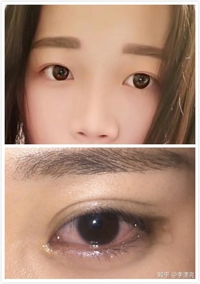 割双眼皮好看吗