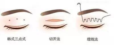 点式双眼皮