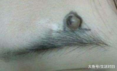 额头的痘痘被击破流血