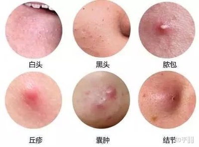 月经前痘痘严重怎么办