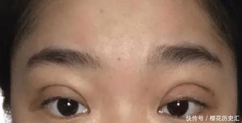 什么年龄双眼皮