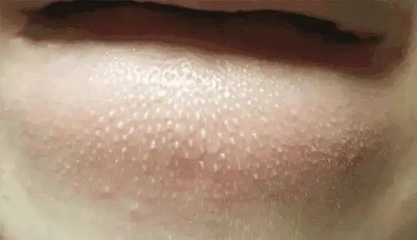 下巴经常长痘痘有白斑