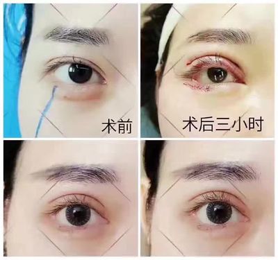 纳米双眼皮后总磨眼睛