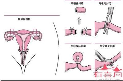 单侧输卵管怀孕的技巧