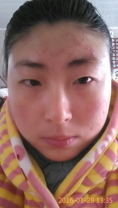 脸上有痘痘不挤会怎样