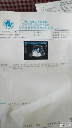 三个月流产疼吗