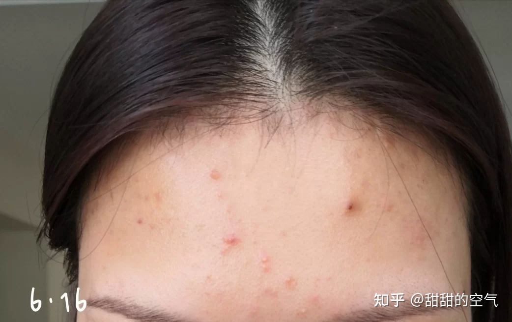长痘痘痛苦