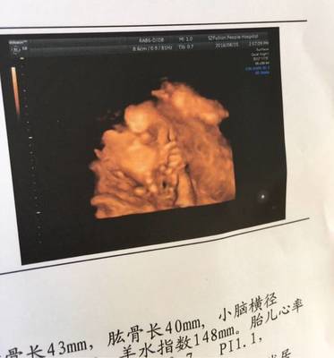 胎儿心率148