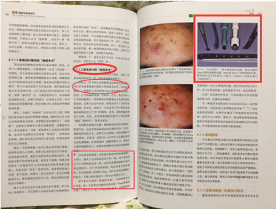 去痘痘根