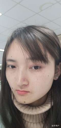 鼻子老是红长痘痘