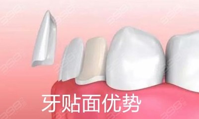 去医院做一颗贴面要多少钱