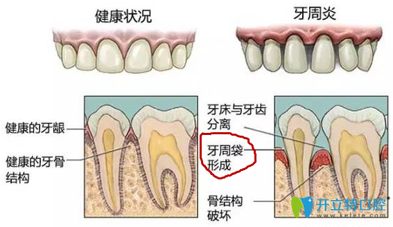 牙齿发炎怎么治疗
