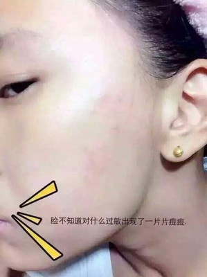 脸上有痘痘能打水光针吗