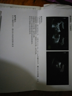 怀孕孕囊图片