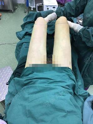 抽脂后疼痛感多久恢复