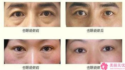 抽脂祛眼袋多少钱