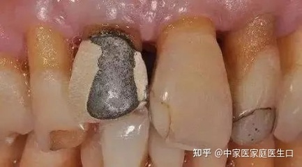 烤瓷牙崩瓷怎么修复