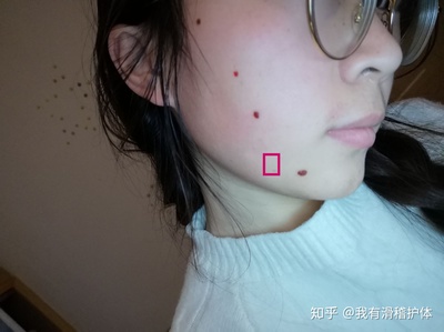 多大的痣可以用激光点