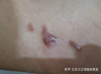 后背上长痘痘怎么回事