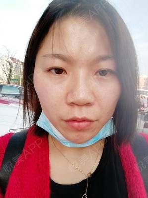 瘦脸针几天有感觉