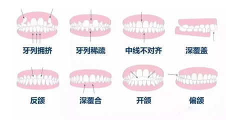 牙齿矫正的费用