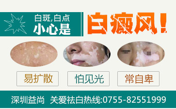 白癜风该怎么治疗好