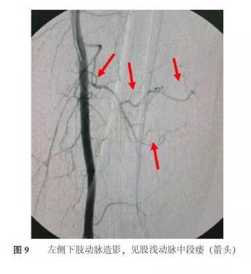 冠状动脉瘘怎么治疗