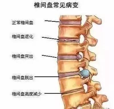 颈椎突出怎么治疗效果好