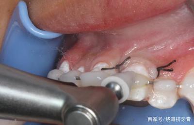 牙齿发炎怎么治疗