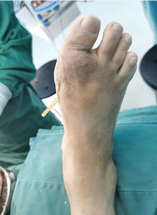 脚趾麻木怎么治疗方法