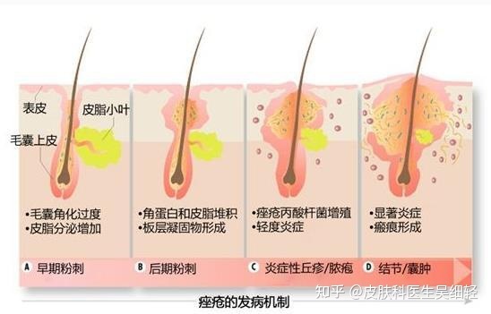 黑头粉刺怎么形成的