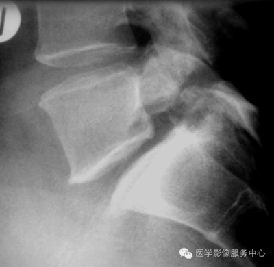 腰5椎弓峡部裂怎么治疗