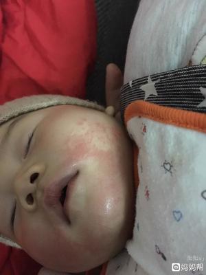 五个月宝宝出疹子怎么办