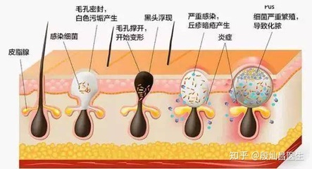 为什么脸部出油严重