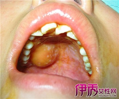 唾液囊肿怎么治疗