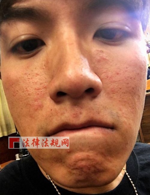 脸过敏痘痘