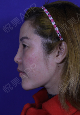 悬吊除皱v美减龄实力