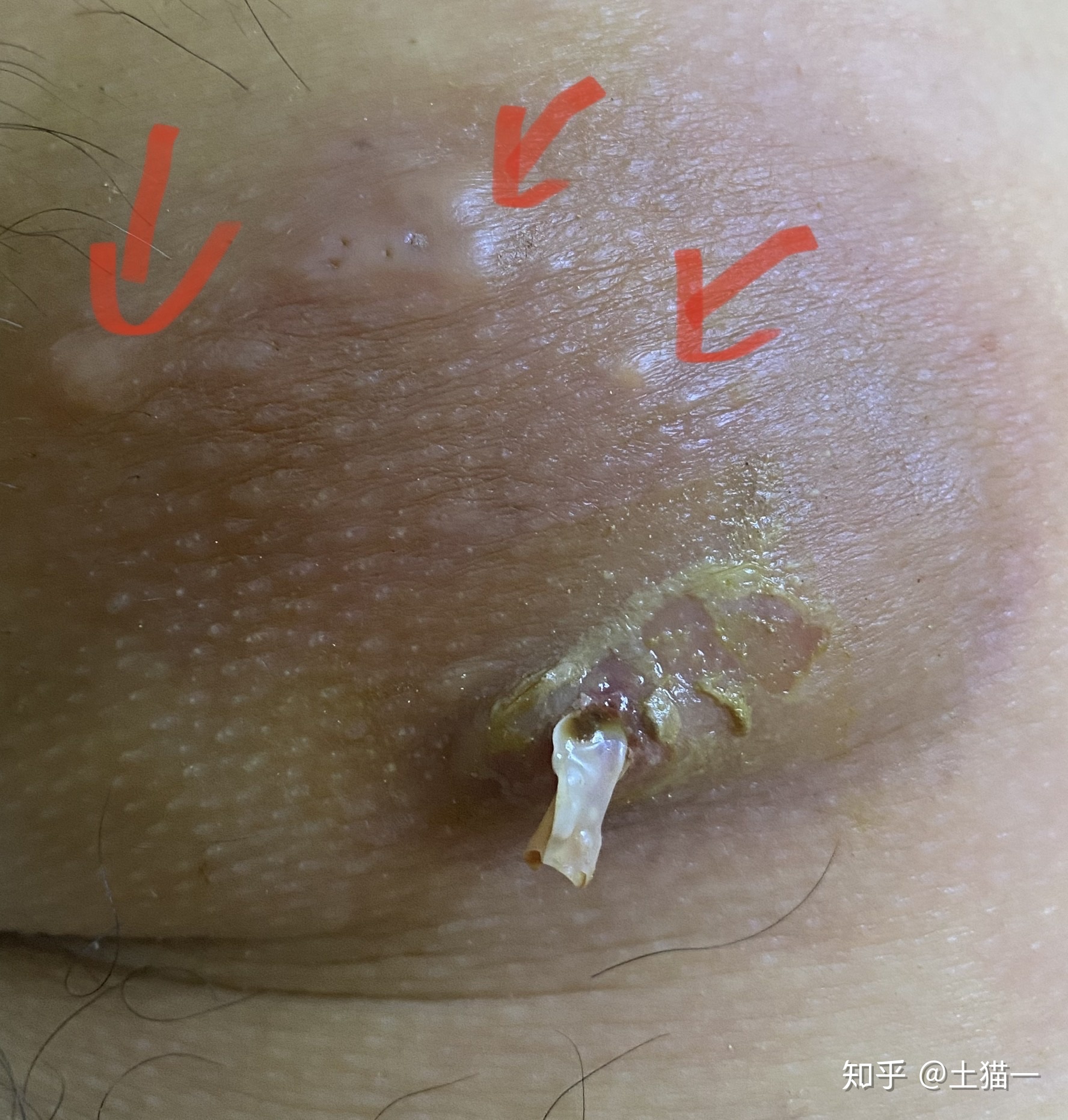 坐板疮怎么治疗