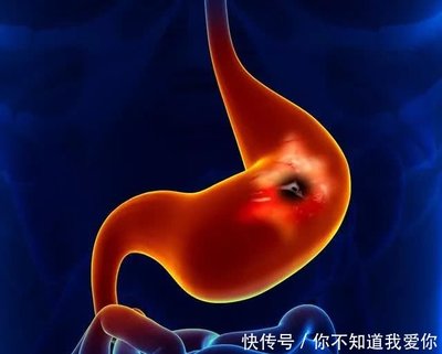 胃溃疡伴出血怎么治疗