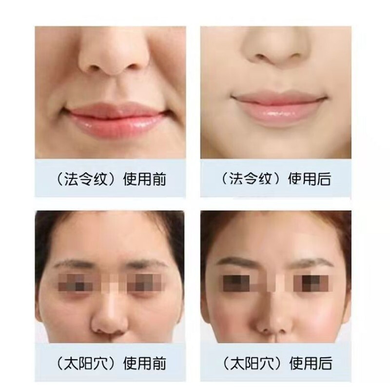胶原蛋白填充法令纹