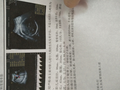 胎儿头偏大是什么原因