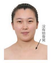锁骨鼓起来是怎么回事