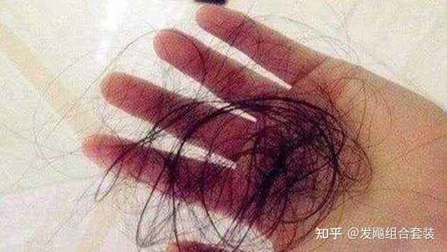 梦见自己掉了头发