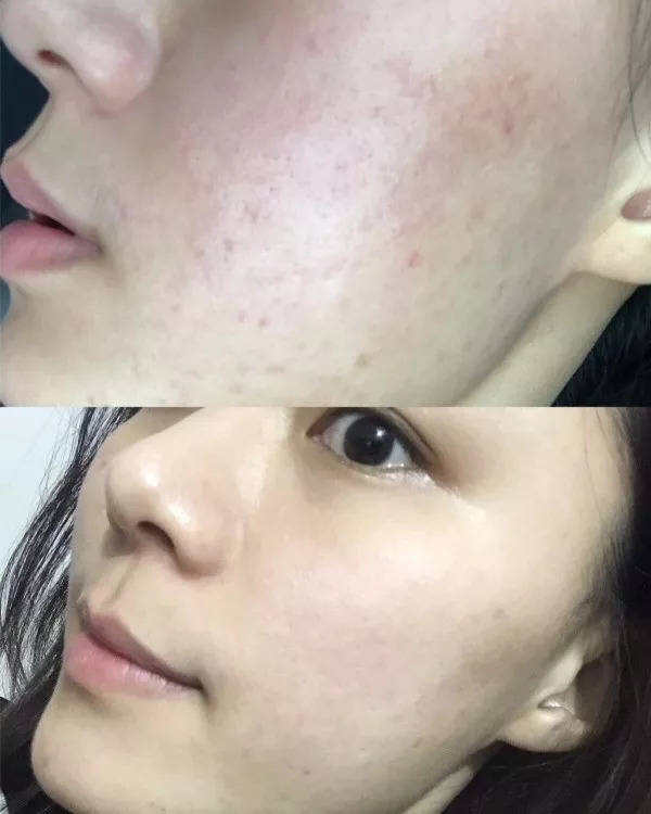 敏感肌痘痘肌