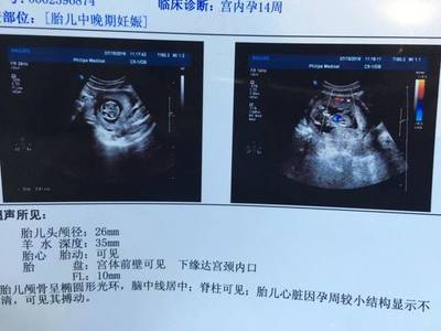 胎儿14周会有胎动吗