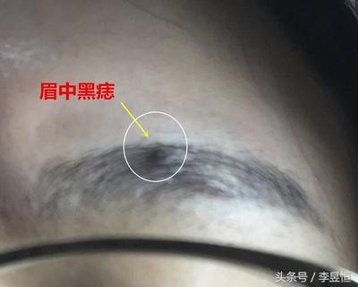 头上有黑痣是怎么回事