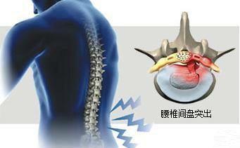 腰椎膨出是膨出多少