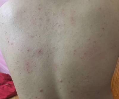 胸前长痘痘有点痒